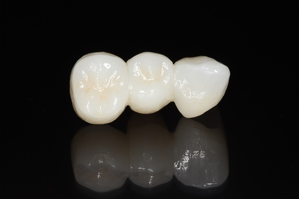 Is It Time For You To Get A Dental Bridge?